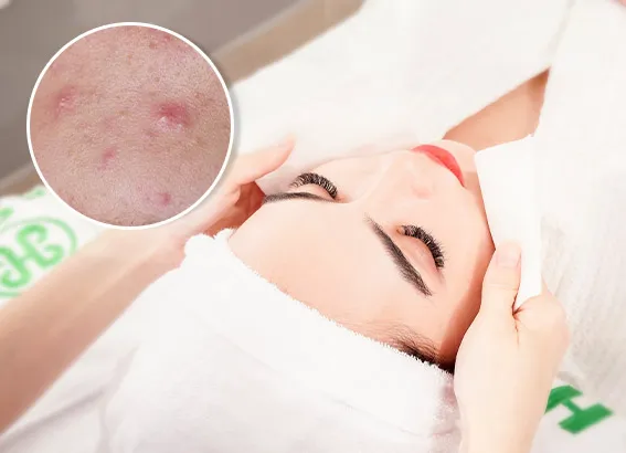 Các nguyên tắc "vàng" khi chăm sóc da sau mụn